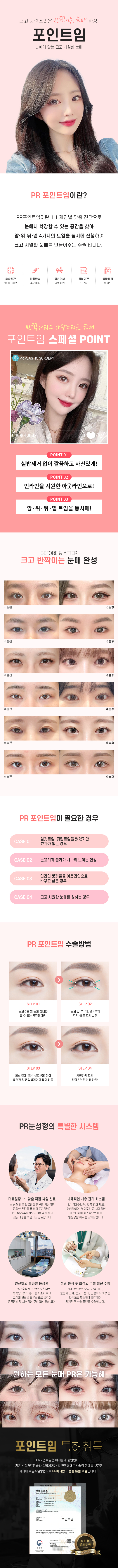 트임수술