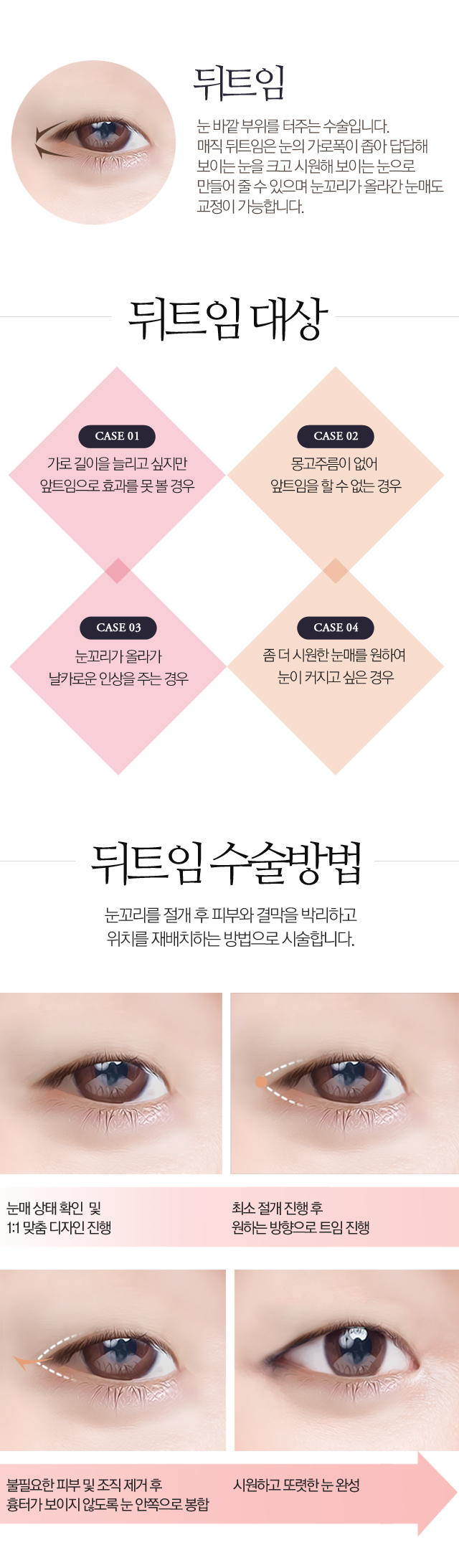 뒤트임