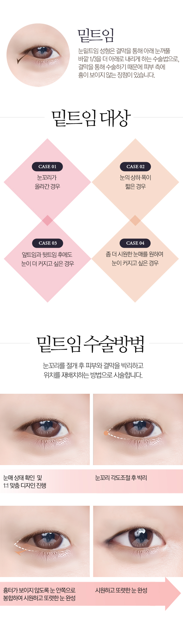 밑트임