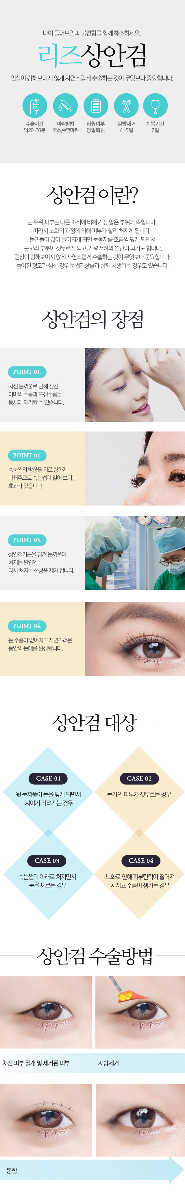 리즈상안검