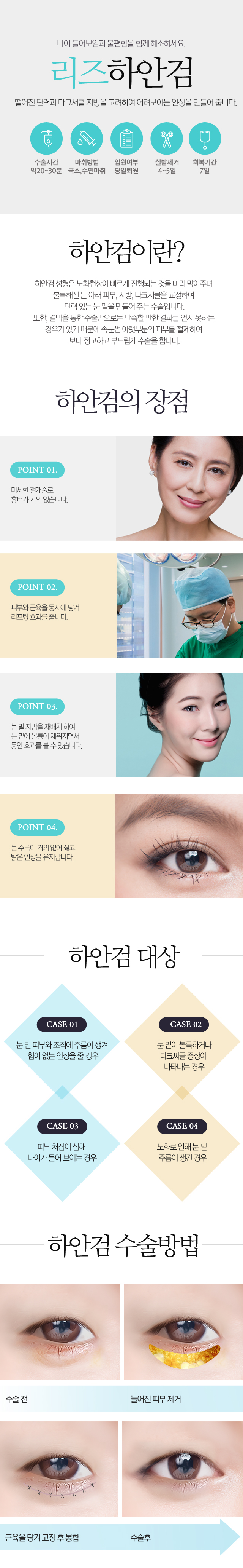 리즈하안검