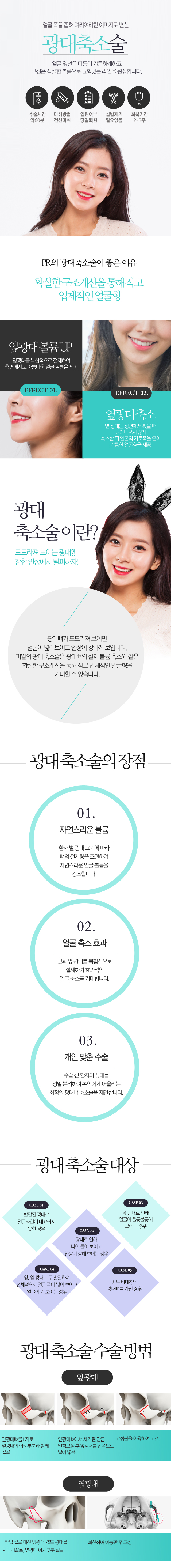 광대축소술
