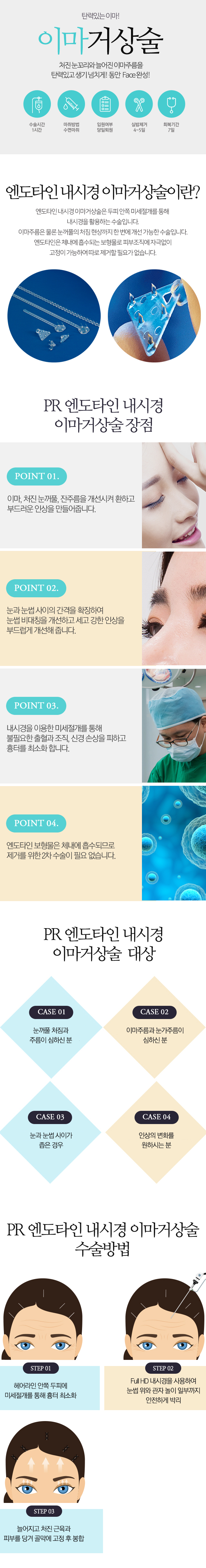 리즈상안검